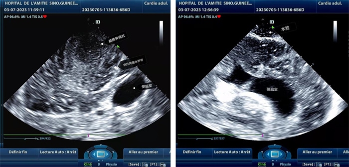 左圖顯示術(shù)中超聲見(jiàn)囊實(shí)性病變，大小約為4x4x3cm，病灶周圍腦組織水腫明顯；右圖為病灶切除后，術(shù)中超聲示術(shù)腔無(wú)病變殘留