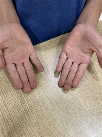 9歲小學(xué)生長(zhǎng)期拍煙卡，手部粗糙長(zhǎng)繭。受訪者供圖